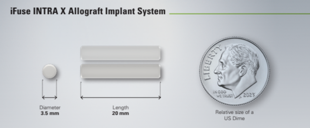 SI Joint Fusion with iFuse INTRA X® Allograft Implant System